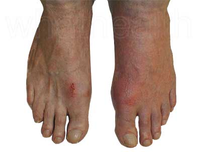 Gout barefoot feet picture Gout of the toe a common affected area