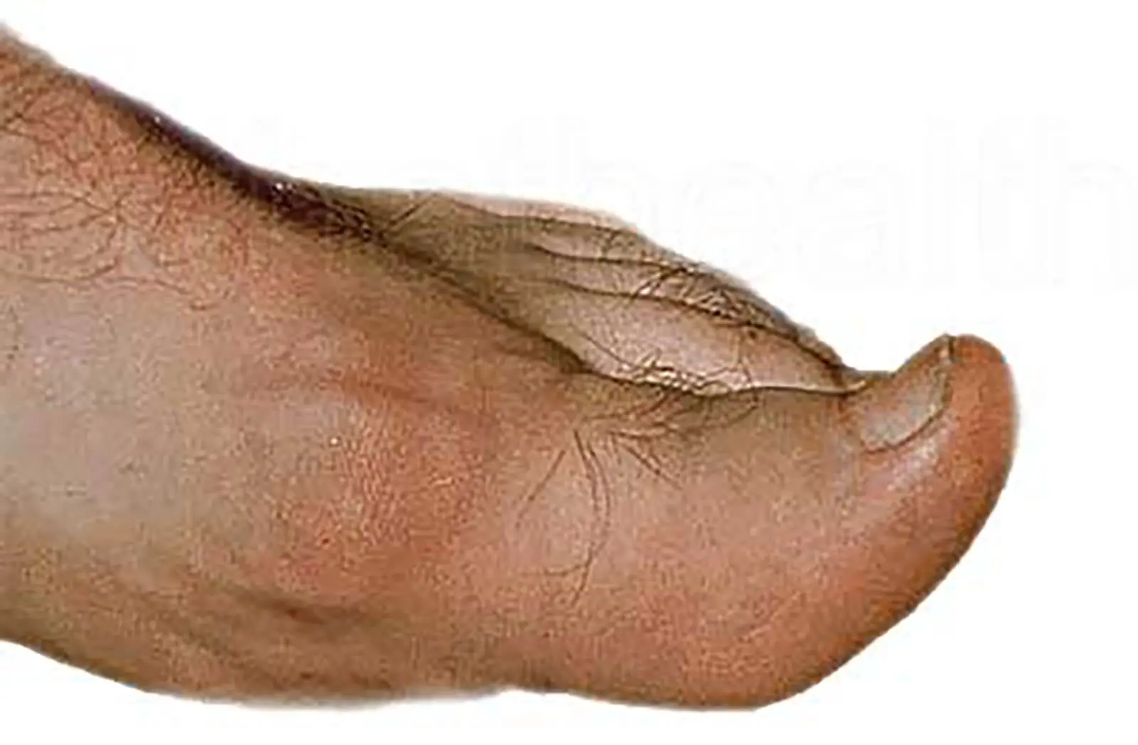 gout-foot.jpg