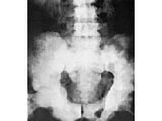 Picture Showing Pelvic Bone Affected By Prostate Cancer