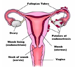 Picture of endometriosis - Diagram of endometriosis in the adbominal cavity.