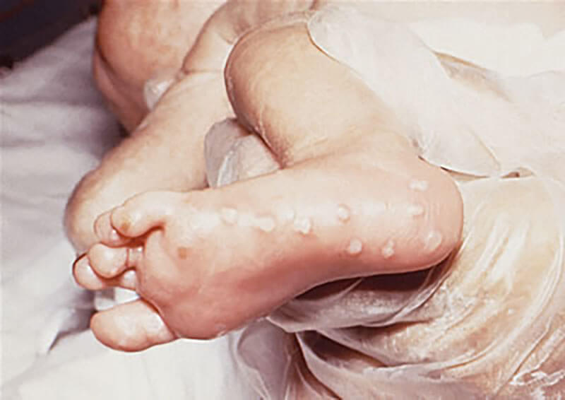 Photo of baby's foot with herpes blistering