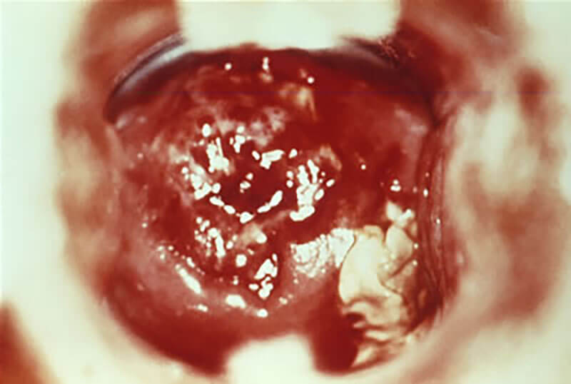 Photo of female genital herpes symptoms