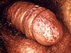 Photo of herpes on the penis