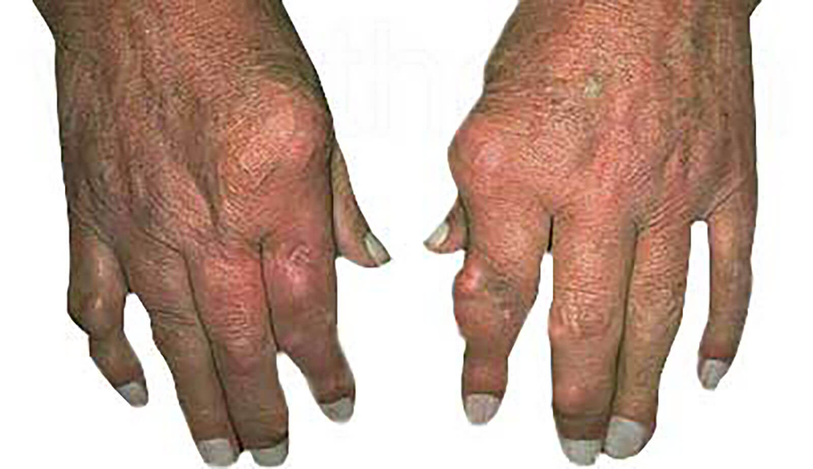 Patients gout affected hands