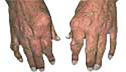 Hand affected by gout