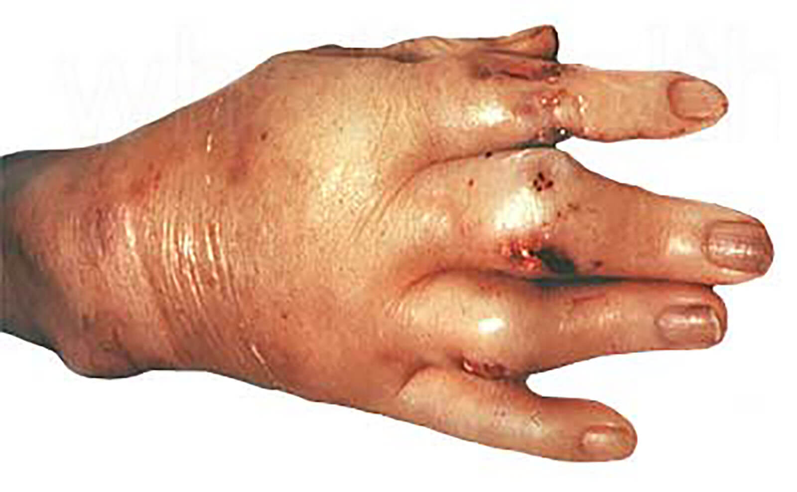 Severe inflammation of a gout affected hand