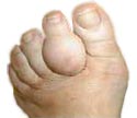 A swollen gout affected toe
