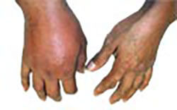 Patients hand affected by gout