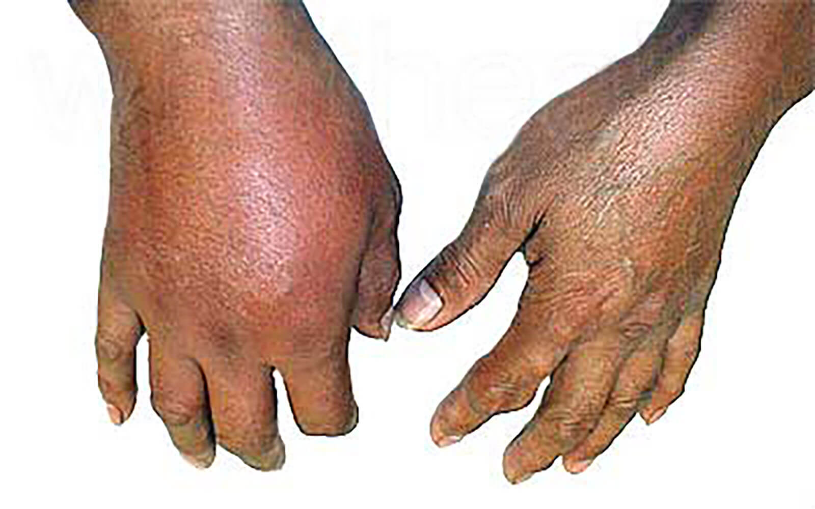 Inflammation of a patients right hand