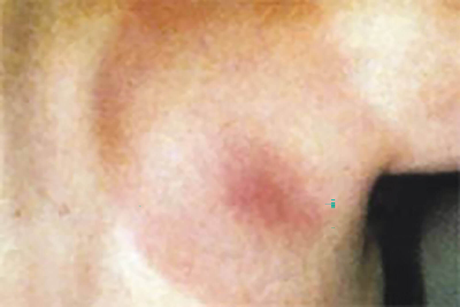 Bulls eye wound of Lyme disease