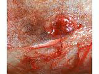 Photo Of Prostate Cancer On The Head