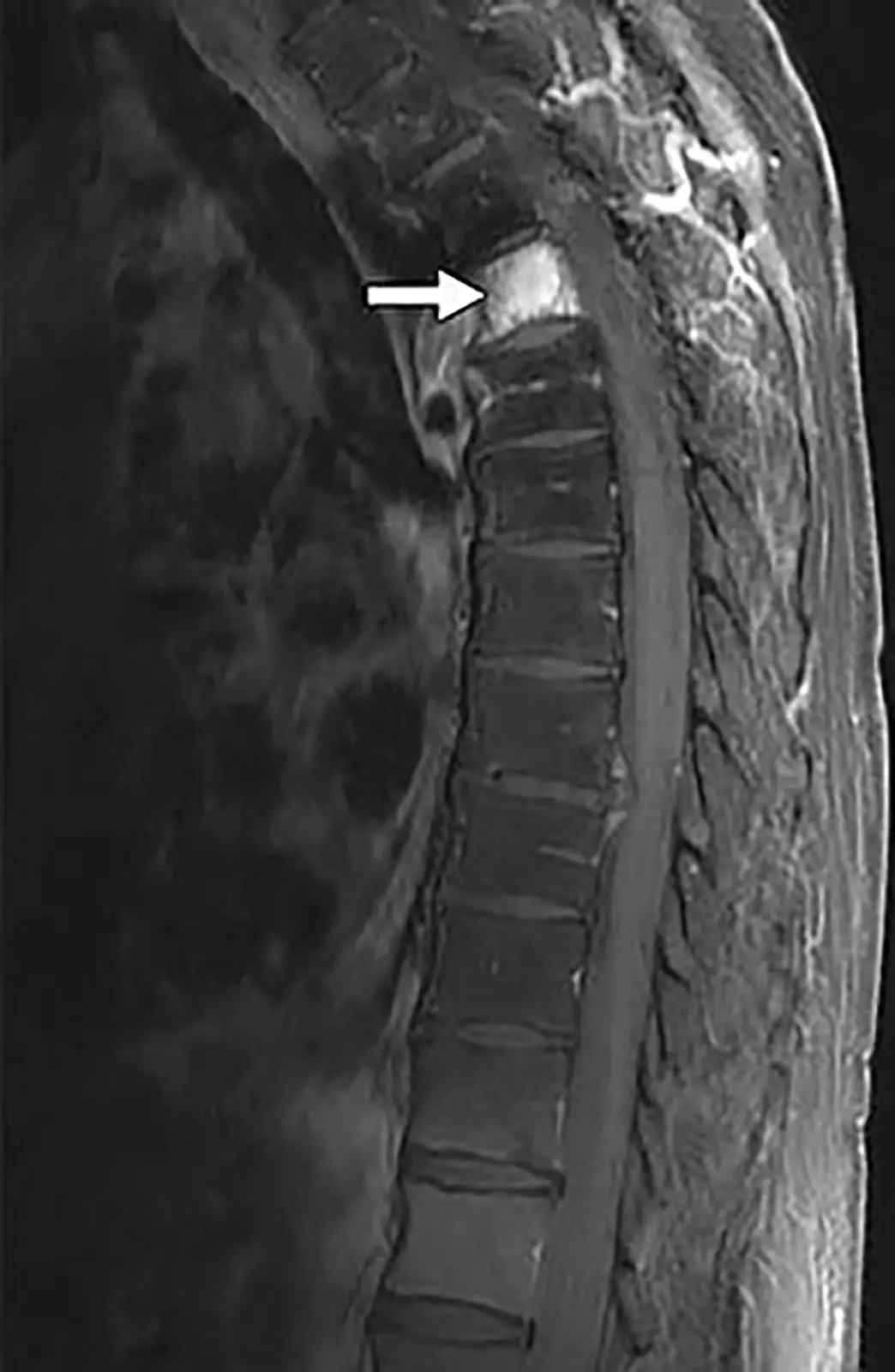Prostate Cancer In The Spine