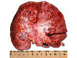 Photo Of Prostate Cancer Which Has Spread To A Kidney