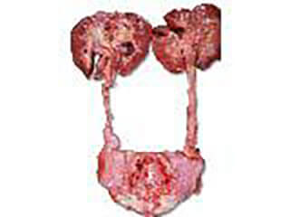Photo Of Prostate Cancer Which Has Spread To Both Kidneys