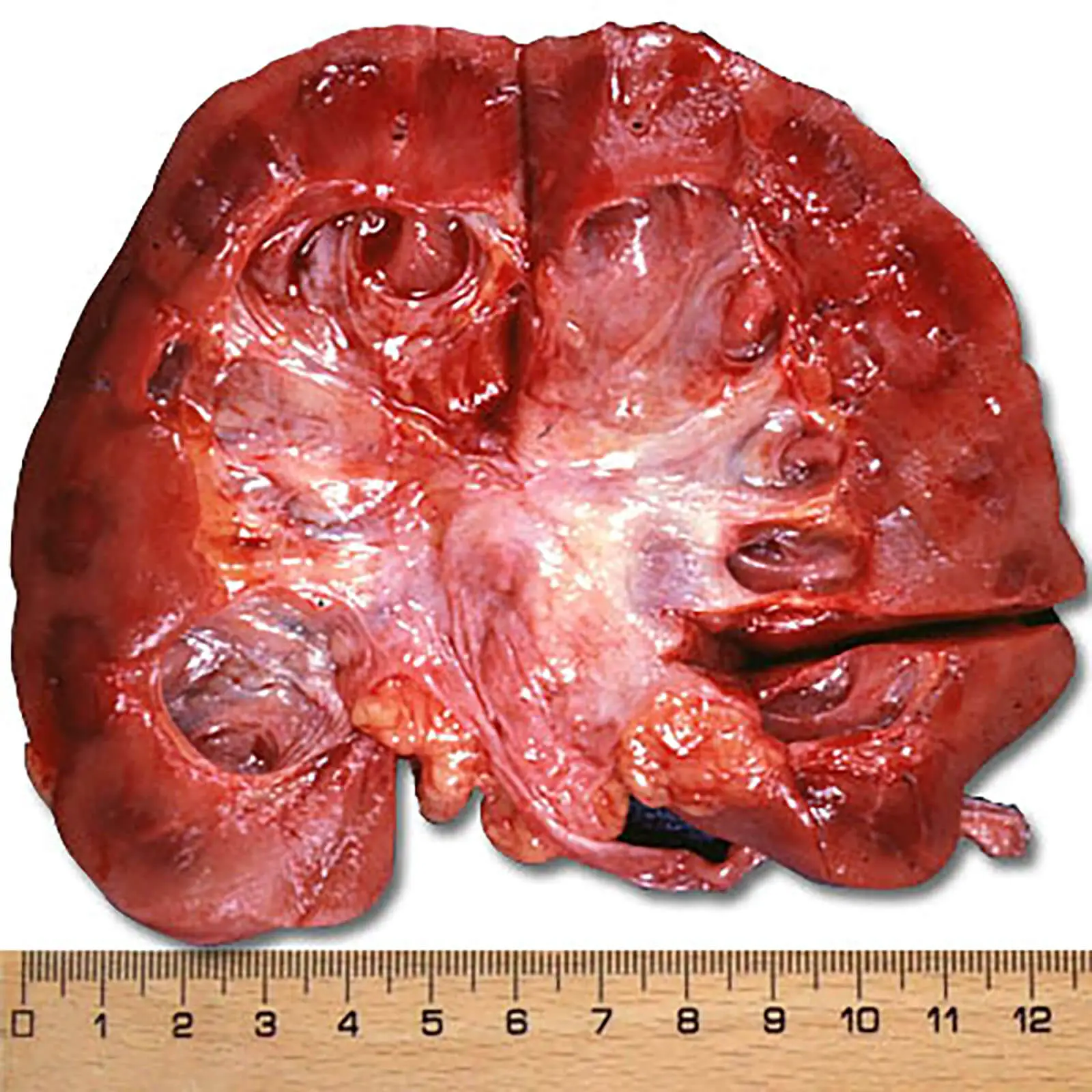 Cancer In A Kidney
