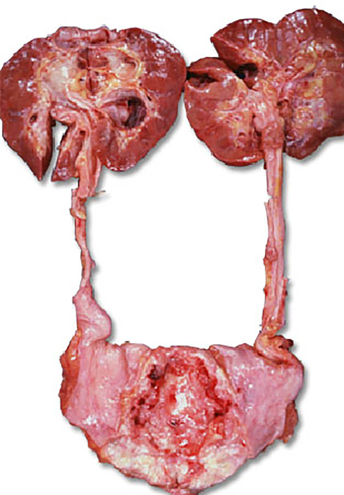 Cancer In The Kidneys & Urinary Tract Cancer In The Kidneys