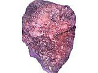 Photo Of A Prostate Gland Removed After Surgery