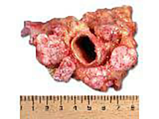 Photo Showing Prostate Cancer Which Has Spread To The Lymph Nodes