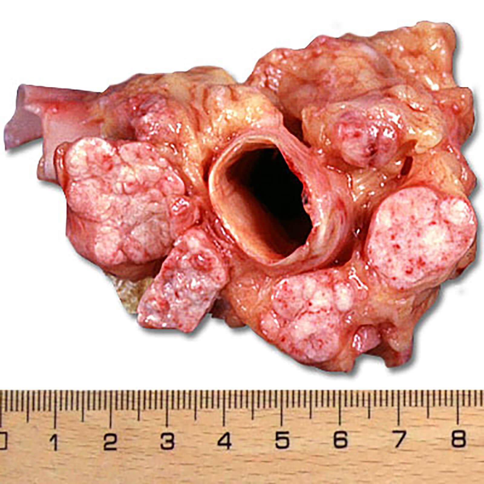 Prostate Cancer On The Lymph Nodes