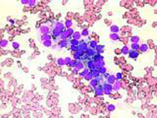Image Of Metastatic Prostate Cancer Cells