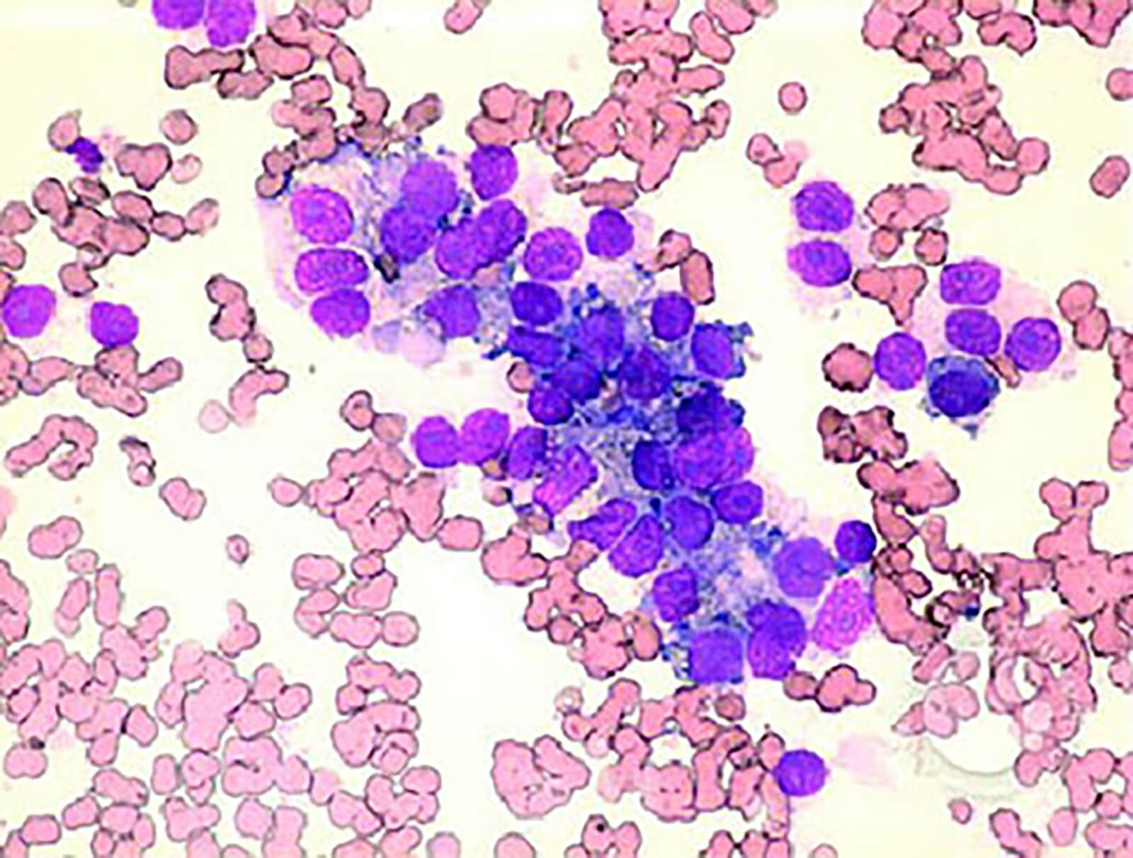 Metastatic Prostate Cancer Cells