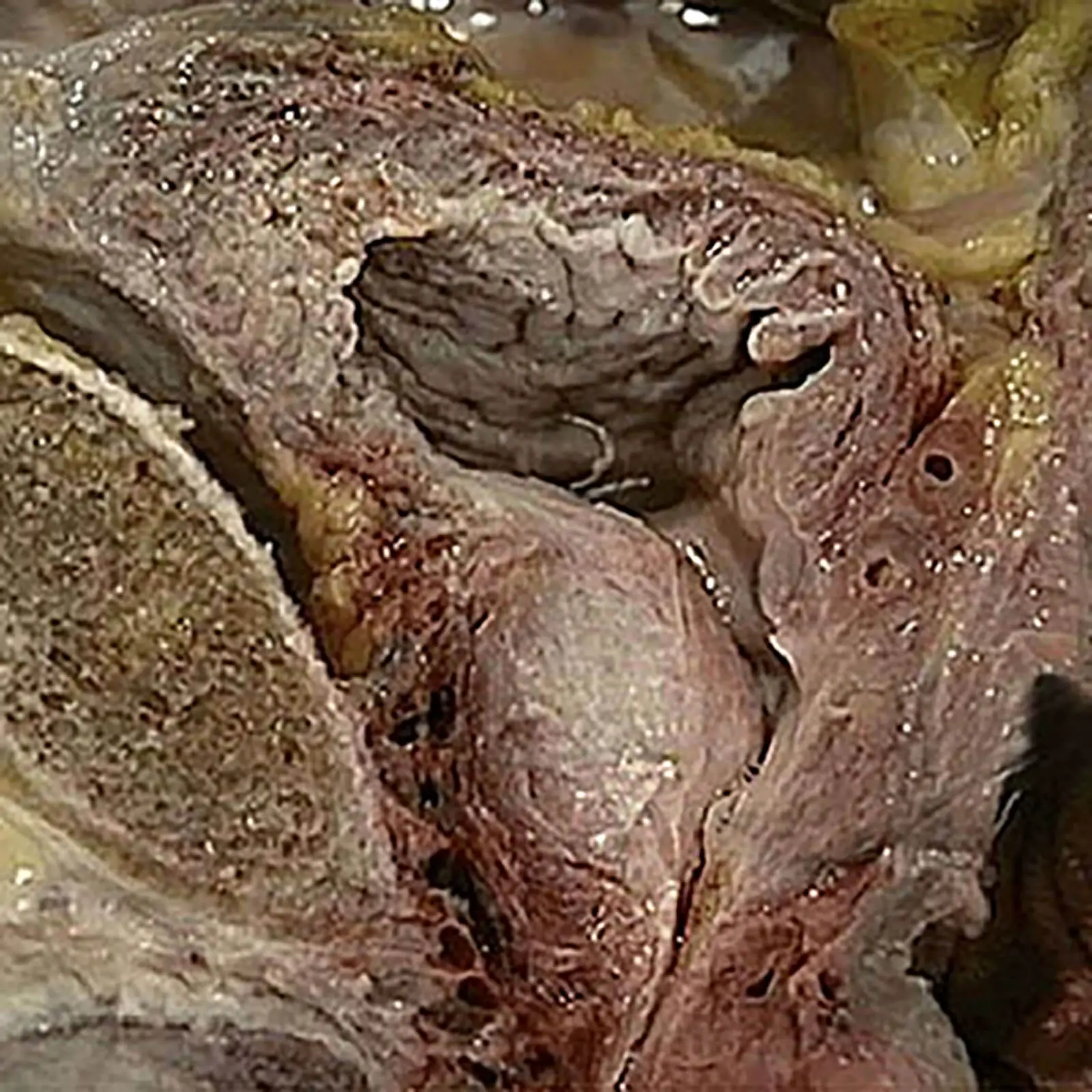 Photo Of A Prostate Gland
