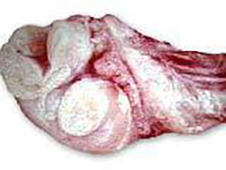 Photo Of Prostate Cancer Which Has Spread To The Testes