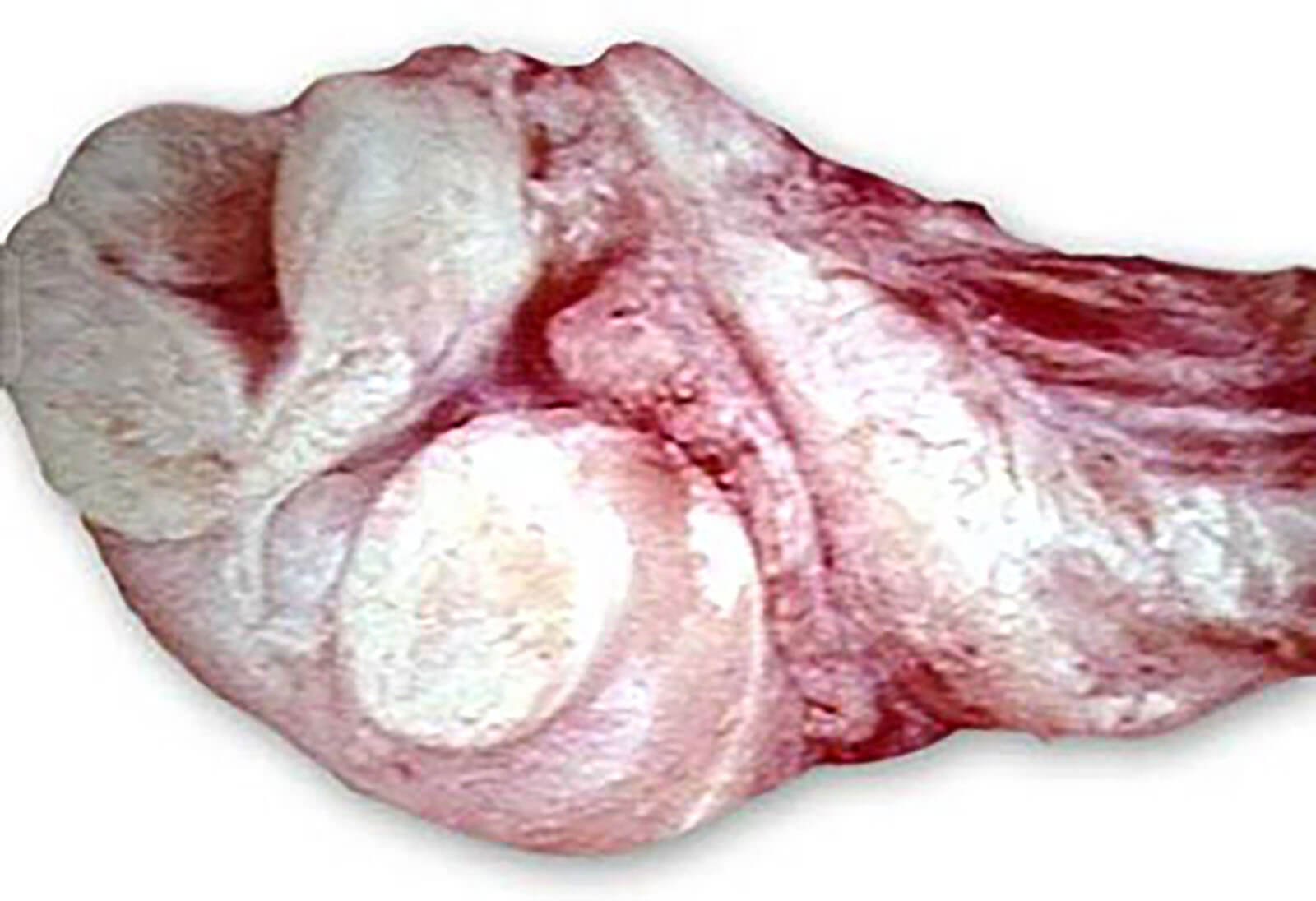 Prostate Cancer Tumor On The Testes