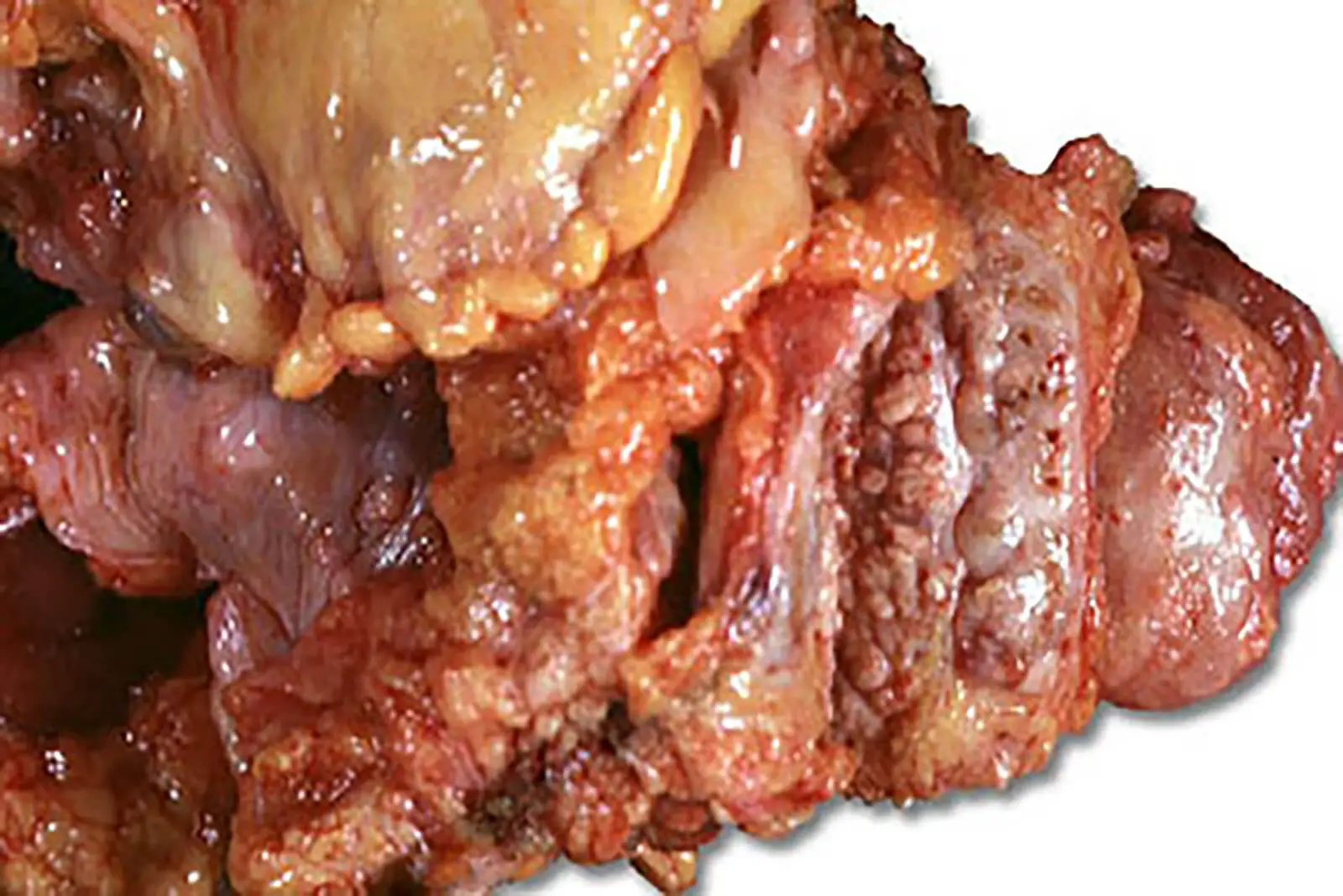 Photo Of A Prostate Cancer Tumor On A Prostate Gland