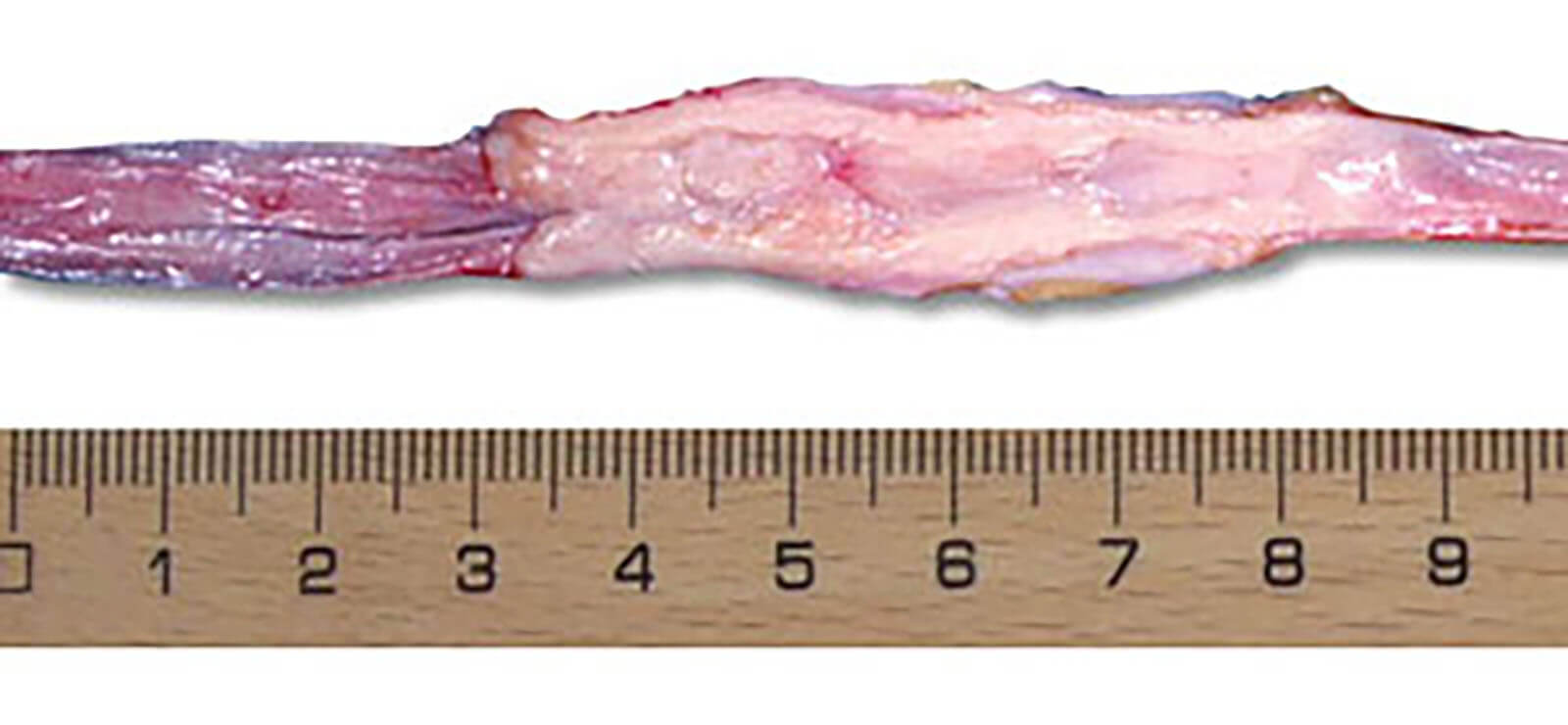 Prostate Cancer On The Ureter Prostate Cancer On The Ureter
