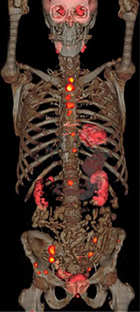 Prostate Cancer Body Scan