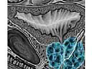 Picture Of An Image Scan Showing An Enlarged Prostate Gland