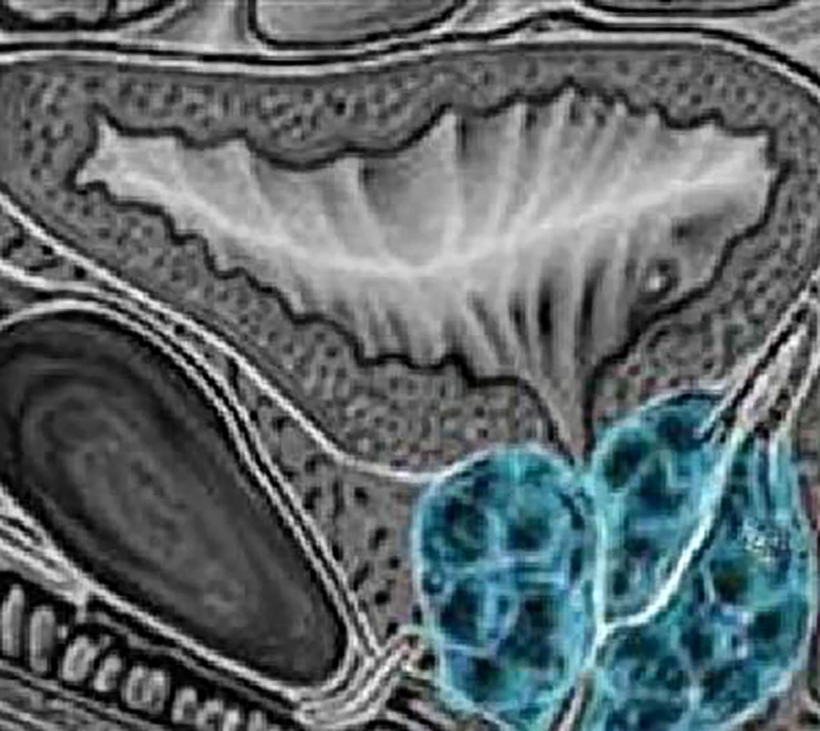 Photo Of An Enlarged Prostate Gland Enlarged Prostate Gland