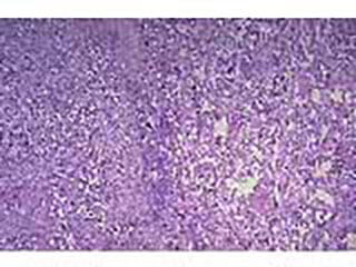 Picture Of Gleason Score Cells