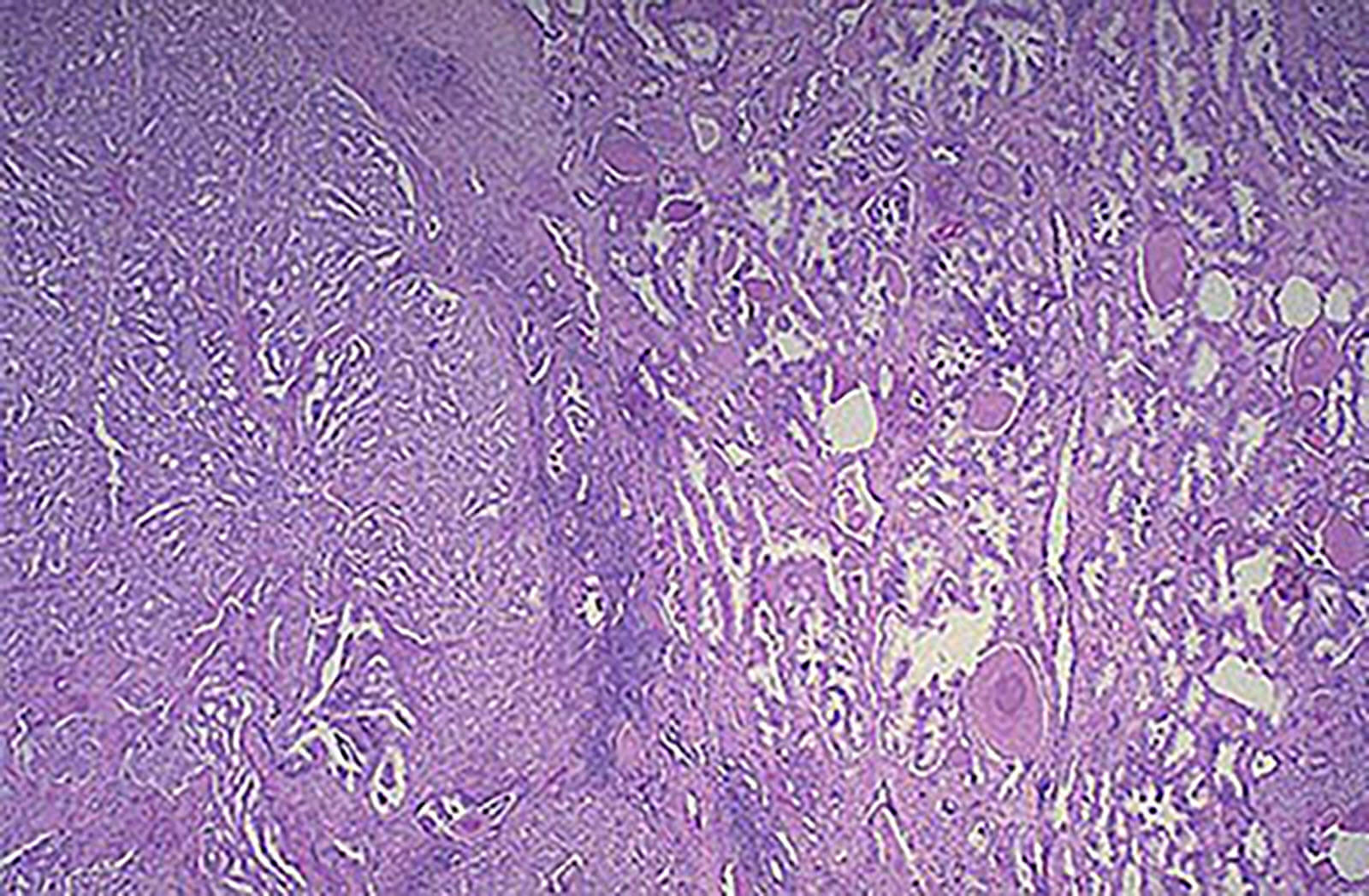 Photo showing the arrangment of healthy and prostate cancer cells