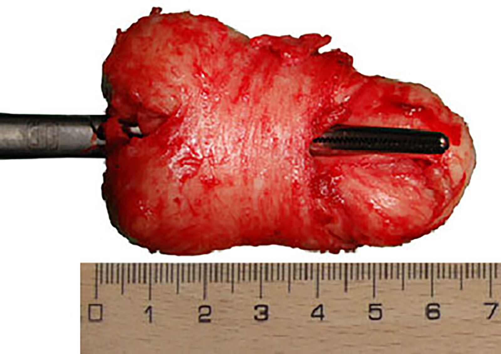 An Enlarged Prostate Gland