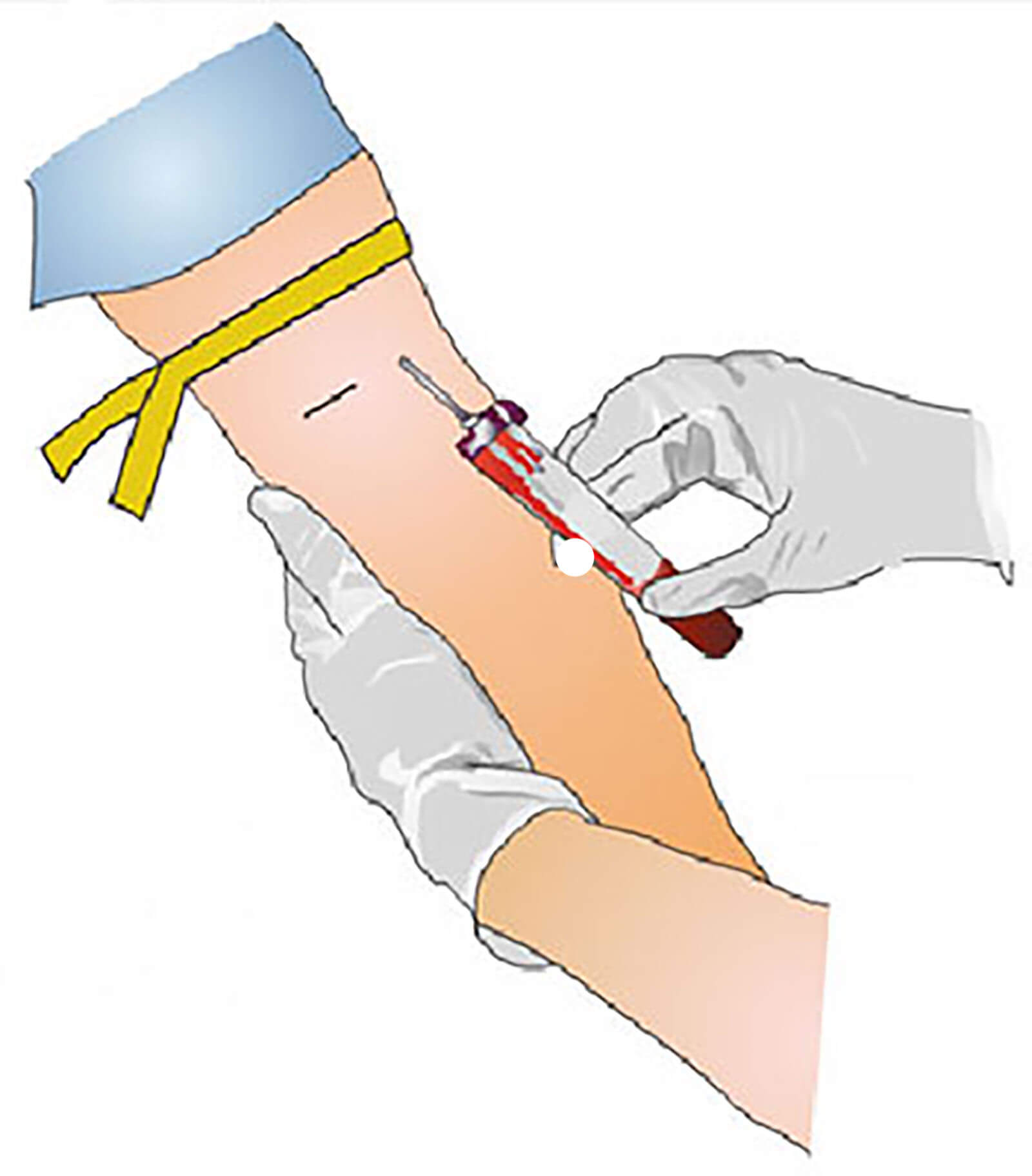 Blood sample taken from patient for a PSA test