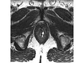 Picture Showing A Removed Prostate Gland