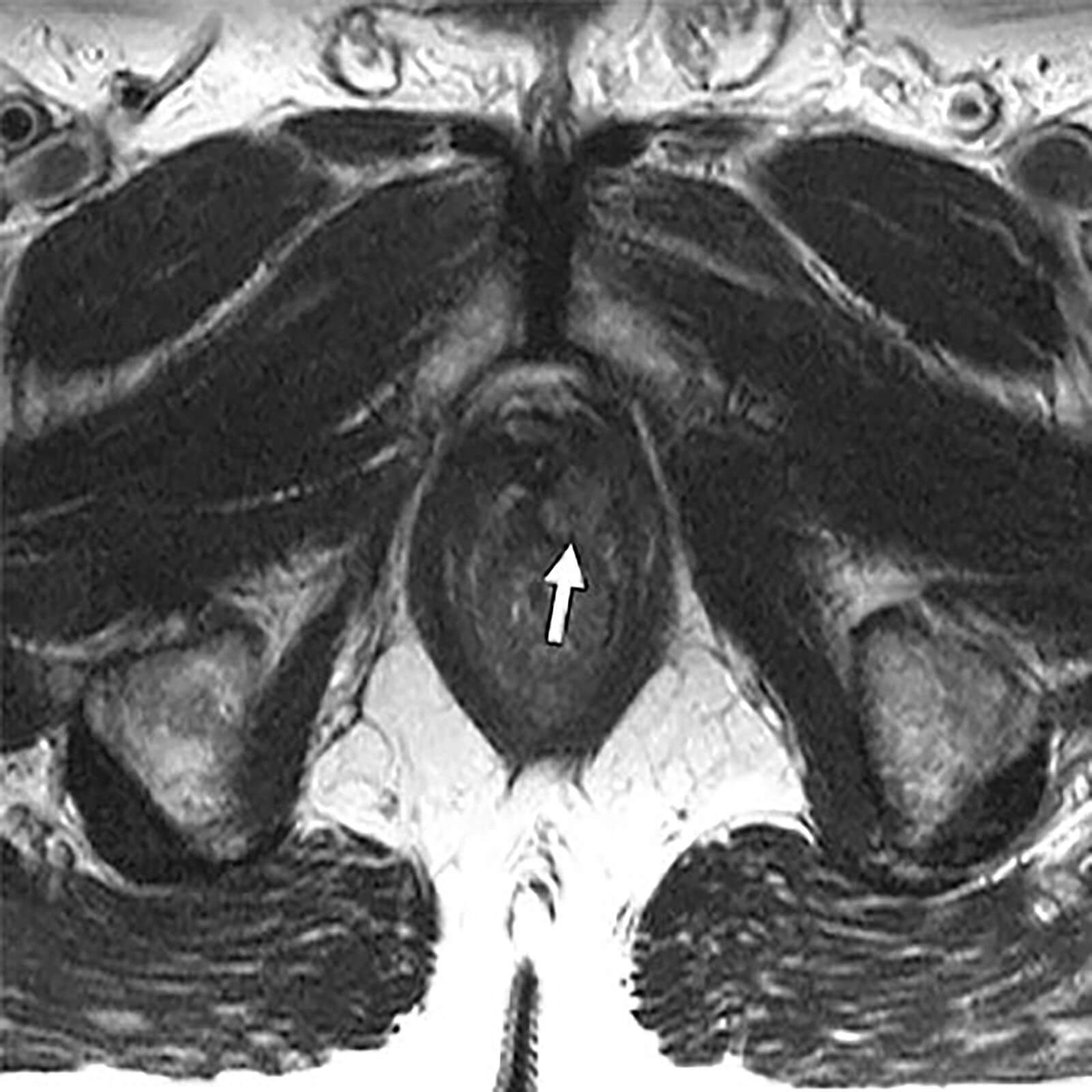 Removed Prostate Gland From A Radical Prostatectomy