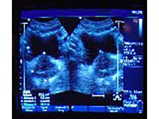 Ultrasound Image Showing Prostate Gland