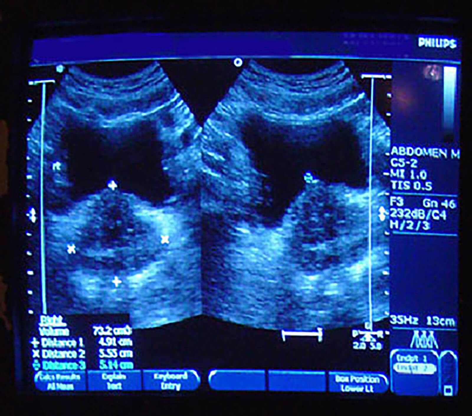 An Ultasound Image Of An Enlarged Prostate Gland Ultrasound Image Of An Enlarged Prostate Gland