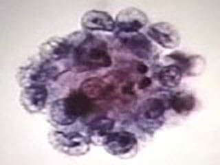 Picture Of Prostate Cancer Cells In Urine