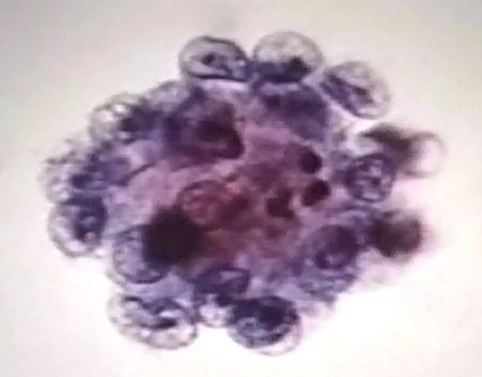 Prostate Cancer Cell In Urine