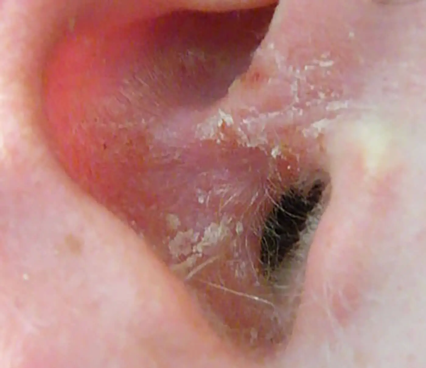 Psoriasis On The Ear