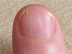 Finger Nail Psoriasis