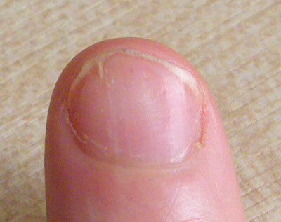 Psoriasis On The Finger Nail