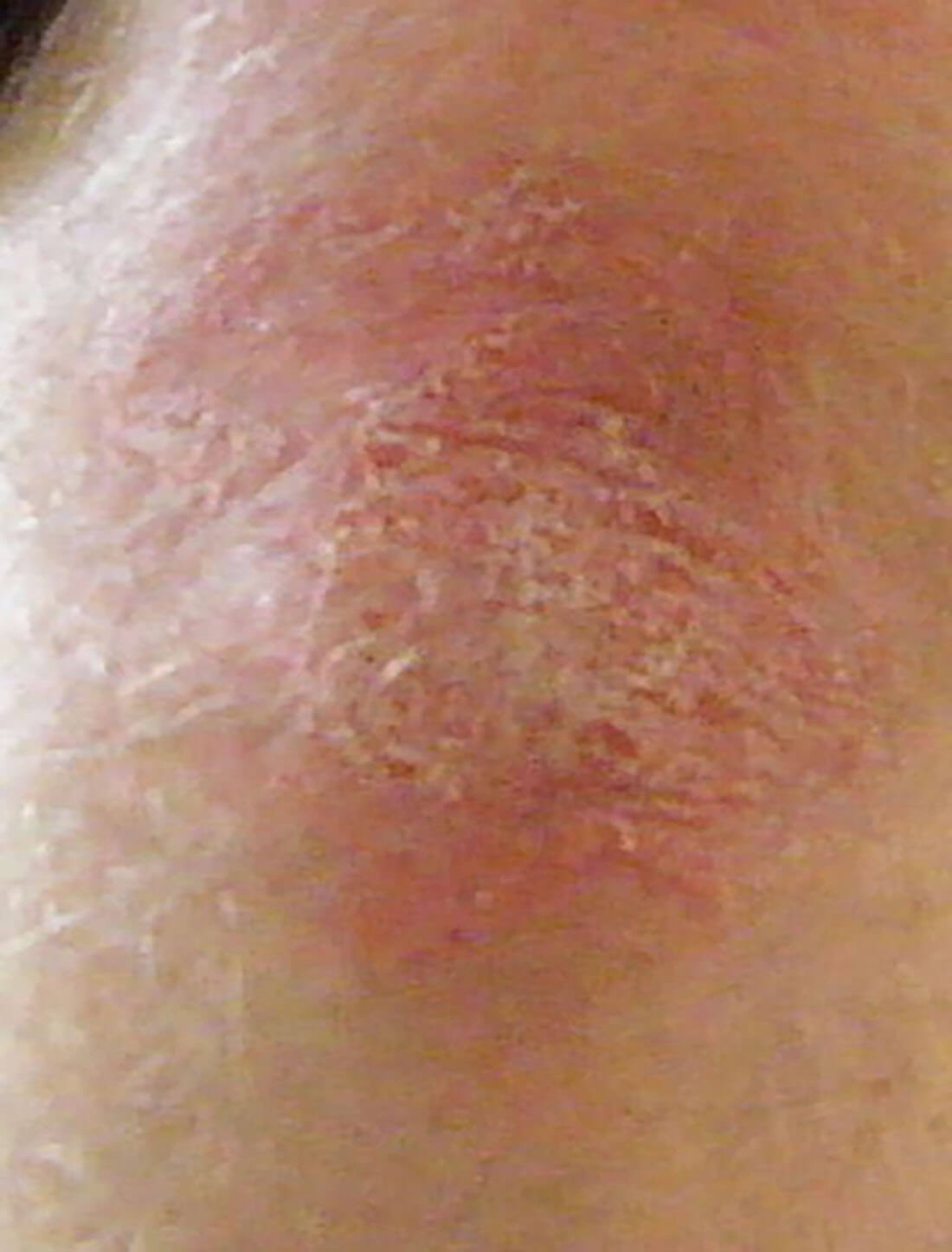 Psoriasis on the knee