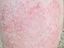 Psoriasis on the leg