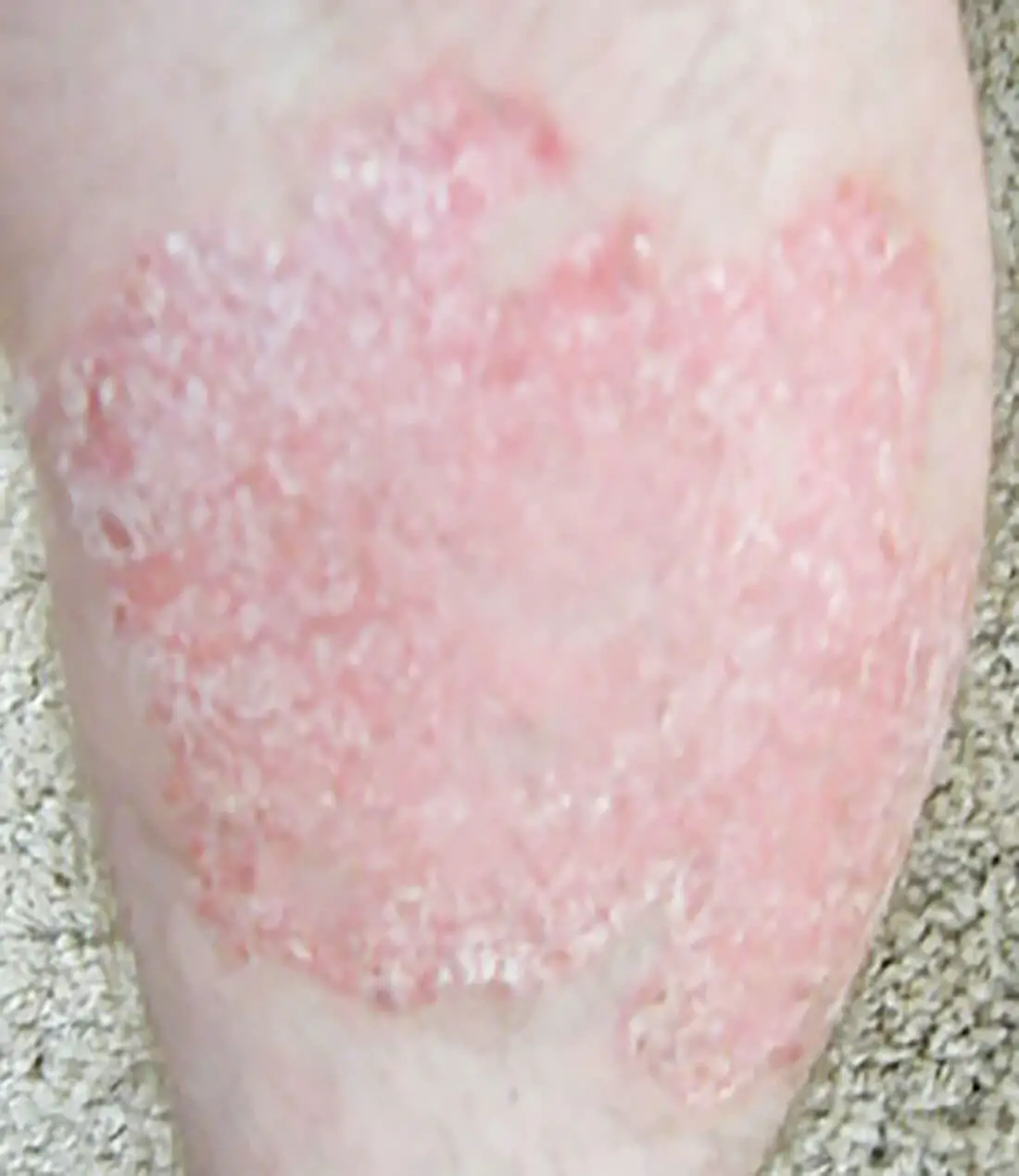 Large Psoriasis Patch On The Leg