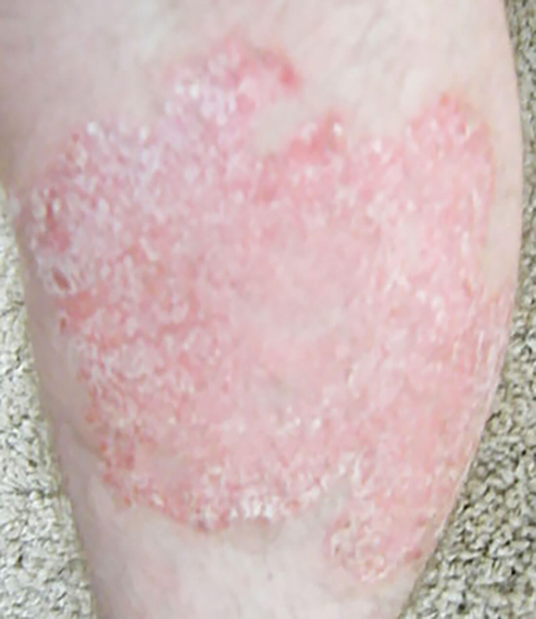 Large Psoriasis Patch On The Leg